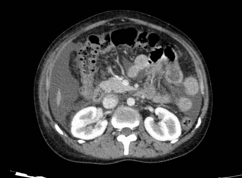 File:Acute Budd-Chiari syndrome (Radiopaedia 60858-68638 Axial C+ portal venous phase 126).jpg