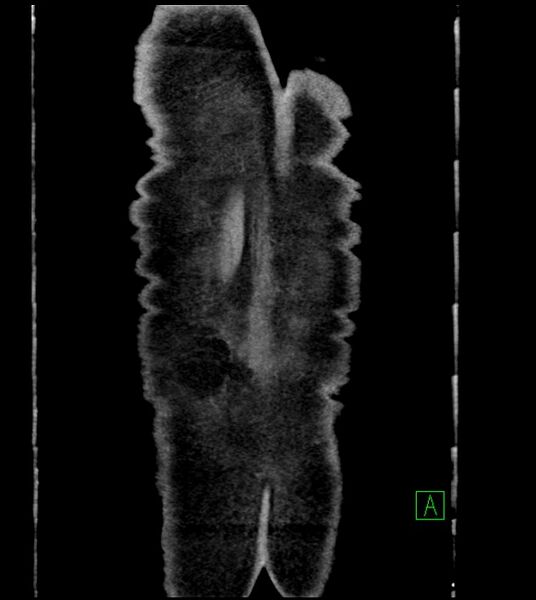 File:Acute arterial mesenteric ischemia (Radiopaedia 78238-90828 Coronal C+ portal venous phase 89).jpg