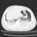 Acute aspiration pneumonitis (Radiopaedia 33605-34703 Axial lung window 76).jpg