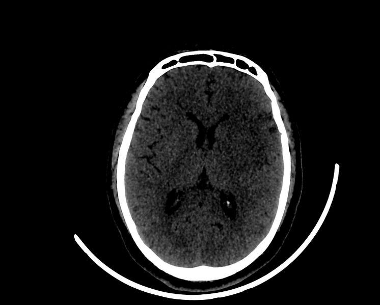 File:Acute cerebral infarct (Radiopaedia 35604-37123 Disappearing basal ganglia sign 1).jpg