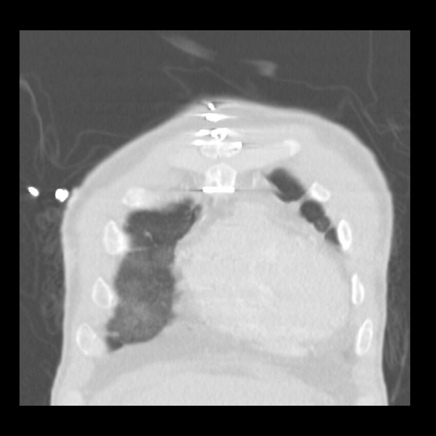 Acute diffuse alveolar hemorrhage (Radiopaedia 41323-44158 Coronal lung window 2).jpg