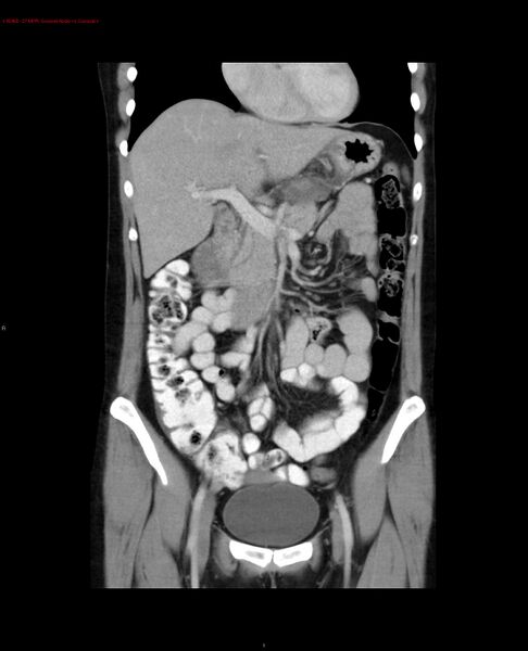 File:Acute gastritis (Radiopaedia 21043-20975 Coronal C+ portal venous phase 17).jpg