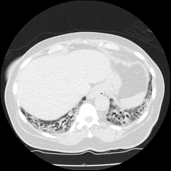File:Acute interstitial pneumonitis (Radiopaedia 45404-49444 Axial lung window 84).jpg