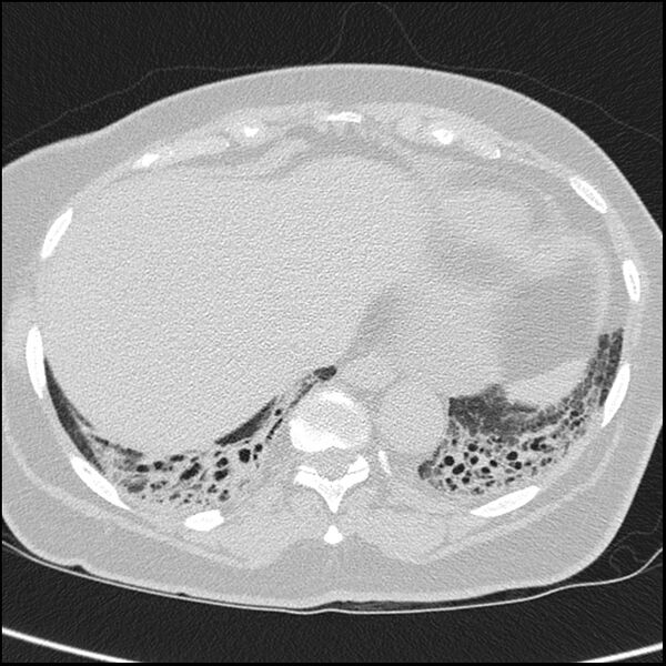 File:Acute interstitial pneumonitis (Radiopaedia 45404-49453 Axial lung window 65).jpg