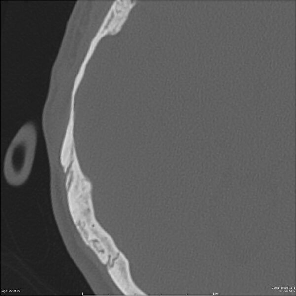 File:Acute otomastoiditis (Radiopaedia 28276-28512 Axial PTB bone window reformat 7).jpg