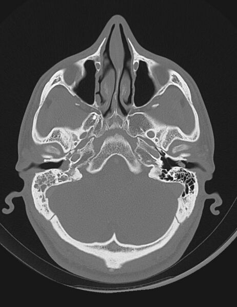 File:Acute otomastoiditis (Radiopaedia 28329-28575 Axial bone window 3).jpg