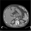 Acute pancreatitis (Radiopaedia 19135-19116 Axial non-contrast 10).jpg