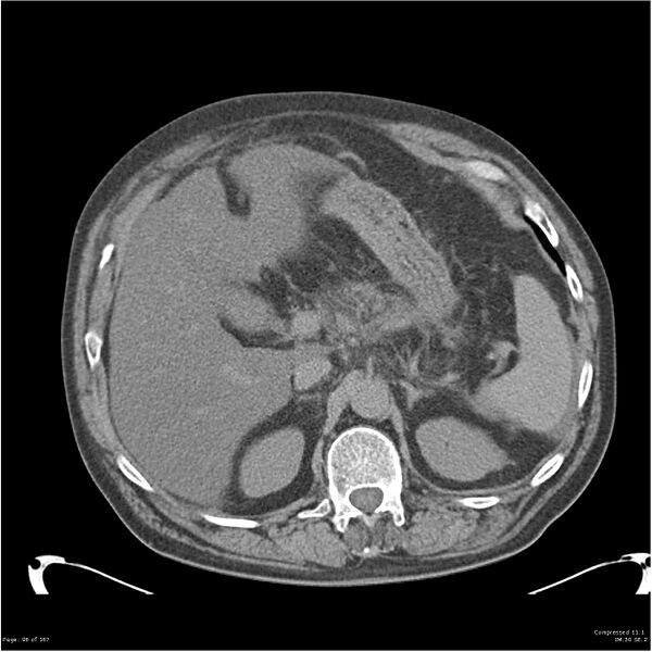 File:Acute pancreatitis (Radiopaedia 19135-19116 Axial non-contrast 10).jpg