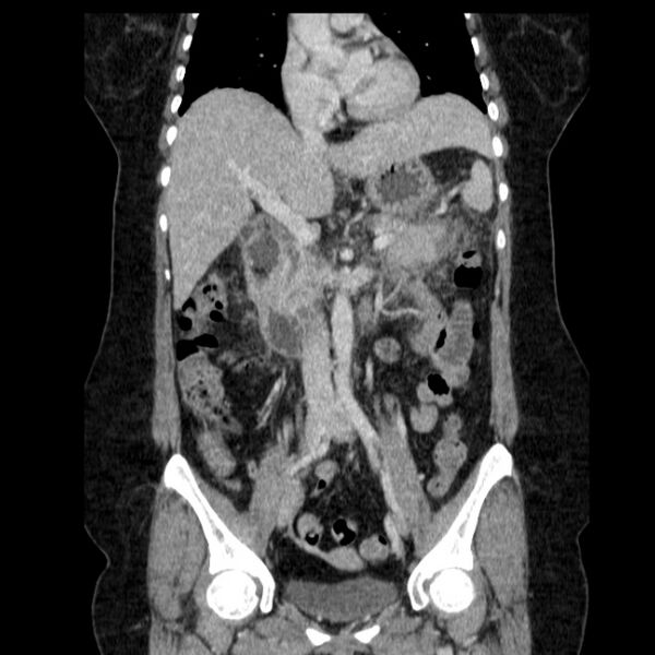 File:Acute pancreatitis - Balthazar C (Radiopaedia 26569-26714 Coronal C+ portal venous phase 34).jpg
