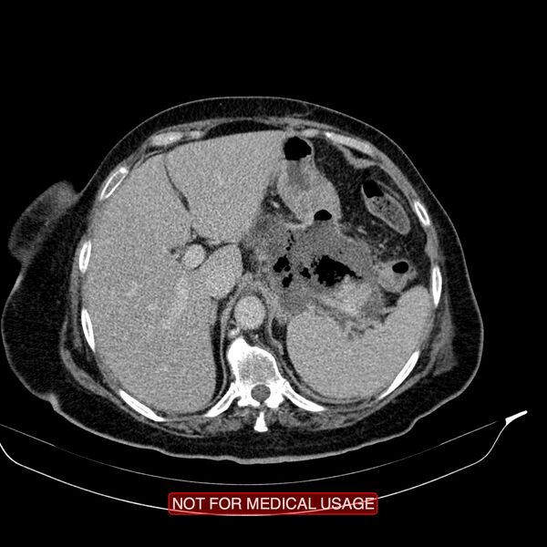 File:Acute pancreatitis with infected necrosis (Radiopaedia 26454-26585 Axial C+ delayed 5).jpg