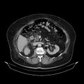 Acute pyelonephritis (Radiopaedia 25657-25837 Axial renal parenchymal phase 33).jpg
