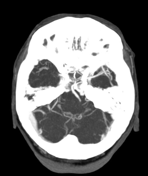 File:Acute right MCA M1 occlusion (Radiopaedia 62268-70454 Axial Phase 2 22).jpg