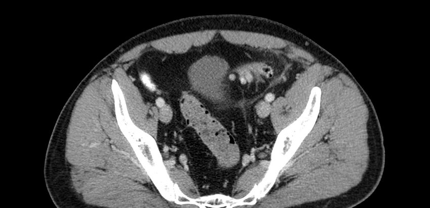 Acute sigmoid colon diverticulitis (Radiopaedia 55507-61976 Axial C+ portal venous phase 92).jpg