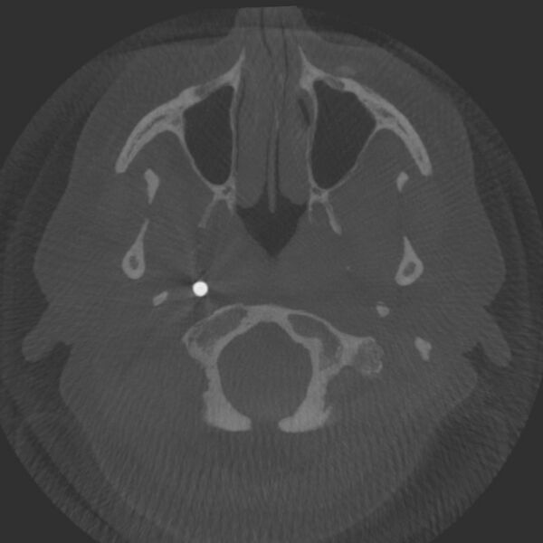 File:Acute subarachnoid hemorrhage and accessory anterior cerebral artery (Radiopaedia 69231-79010 Axial arterial - MIP 2).jpg