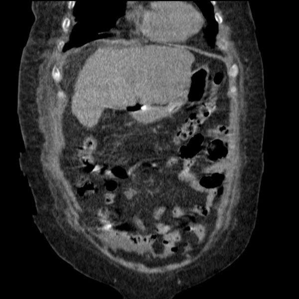 File:Acute tubular necrosis (Radiopaedia 28077-28334 G 26).jpg
