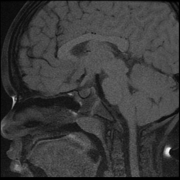 File:Adamantinomatous craniopharyngioma (Radiopaedia 77407-89529 Sagittal T1 fat sat 6).jpg