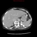 Adenocarcinoma of the colon (Radiopaedia 8191-9039 Axial renal excretory phase 3).jpg