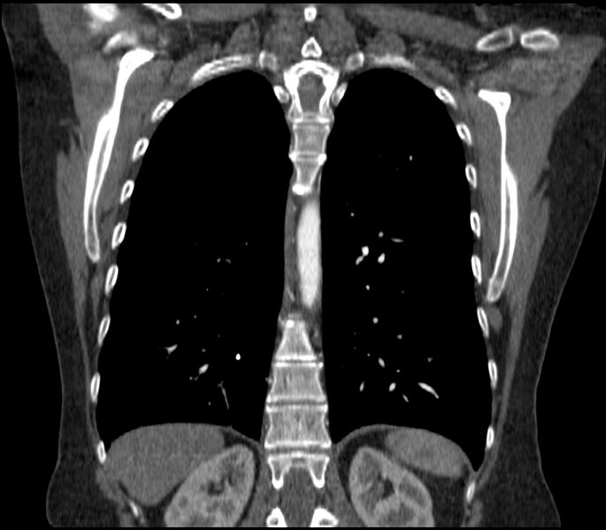 File:Adenocarcinoma of the lung (Radiopaedia 44205-47803 Coronal C+ portal venous phase 69).jpg