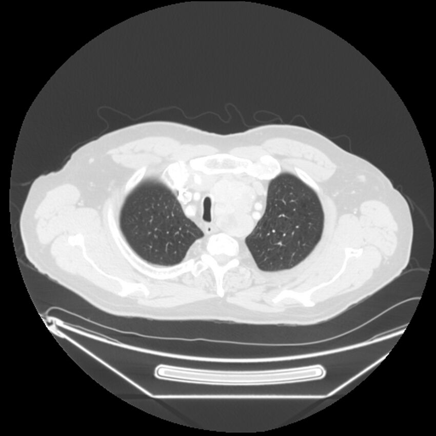 Adenocarcinoma of the lung (Radiopaedia 44876-48759 Axial lung window 10).jpg