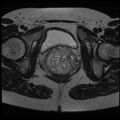 Adenoma malignum of the cervix (Radiopaedia 24460-24765 C 20).jpg