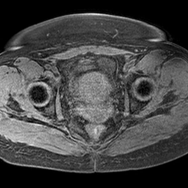 File:Adenomyoma of the uterus (Radiopaedia 9871-10439 Axial T1 fat sat 8).jpg