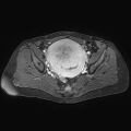 Adenomyoma of the uterus (huge) (Radiopaedia 9870-10438 Axial T1 C+ fat sat 17).jpg