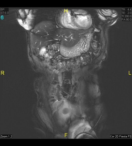 File:Adenomyosis (Radiopaedia 43504-46889 Coronal 2D FIESTA 6).jpg