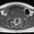 Adenomyosis - ovarian endometriomas (Radiopaedia 67031-76350 Axial T1 11).jpg