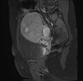 Adenomyosis - ovarian endometriomas (Radiopaedia 67031-76350 Sagittal T1 C+ fat sat 17).jpg