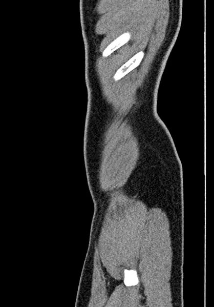 File:Adhesional small bowel obstruction (Radiopaedia 58900-66131 Sagittal C+ portal venous phase 12).jpg