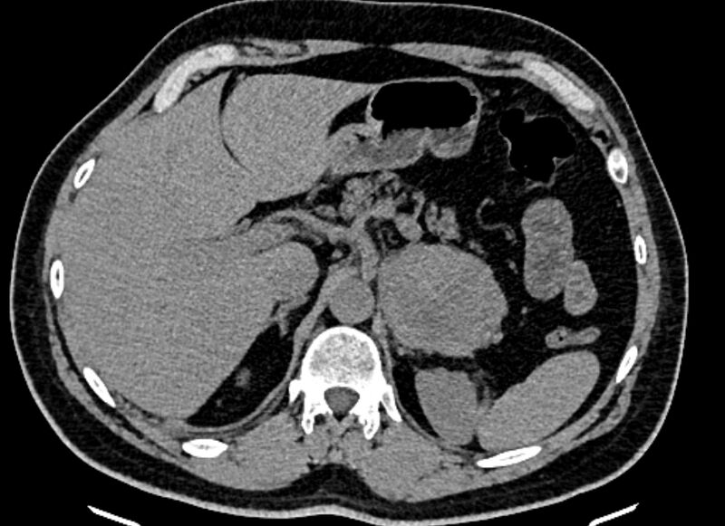 File:Adrenal metastases (Radiopaedia 73082-83791 Axial non-contrast 47).jpg
