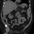 Adrenal myelolipoma (Radiopaedia 8216-9068 non-contrast 3).jpg