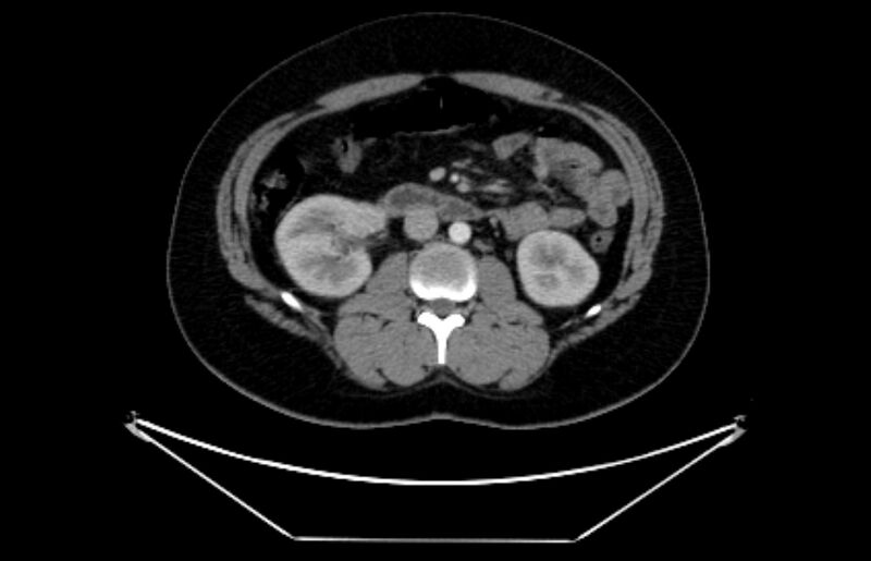 File:Adrenocortical carcinoma (Radiopaedia 80134-93438 Axial C+ portal venous phase 62).jpg