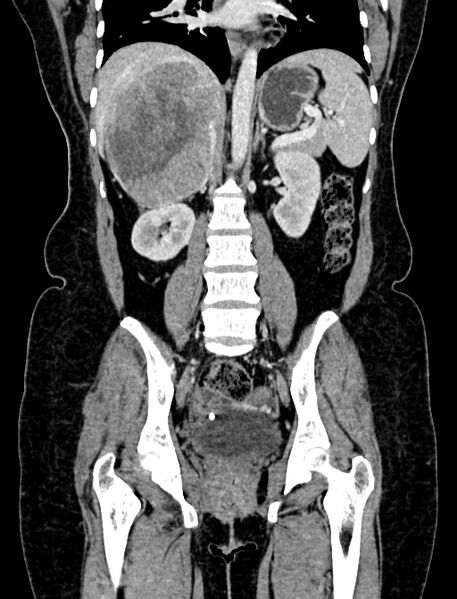 File:Adrenocortical carcinoma (Radiopaedia 87281-103569 Coronal C+ portal venous phase 71).jpg