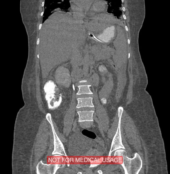 File:Amoebic enterocolitis with liver abscess (Radiopaedia 35100-36609 B 111).jpg
