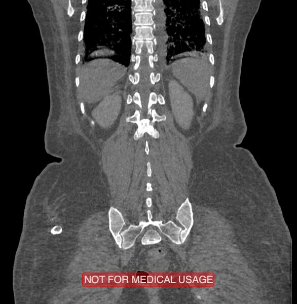 File:Amoebic enterocolitis with liver abscess (Radiopaedia 35100-36609 B 172).jpg