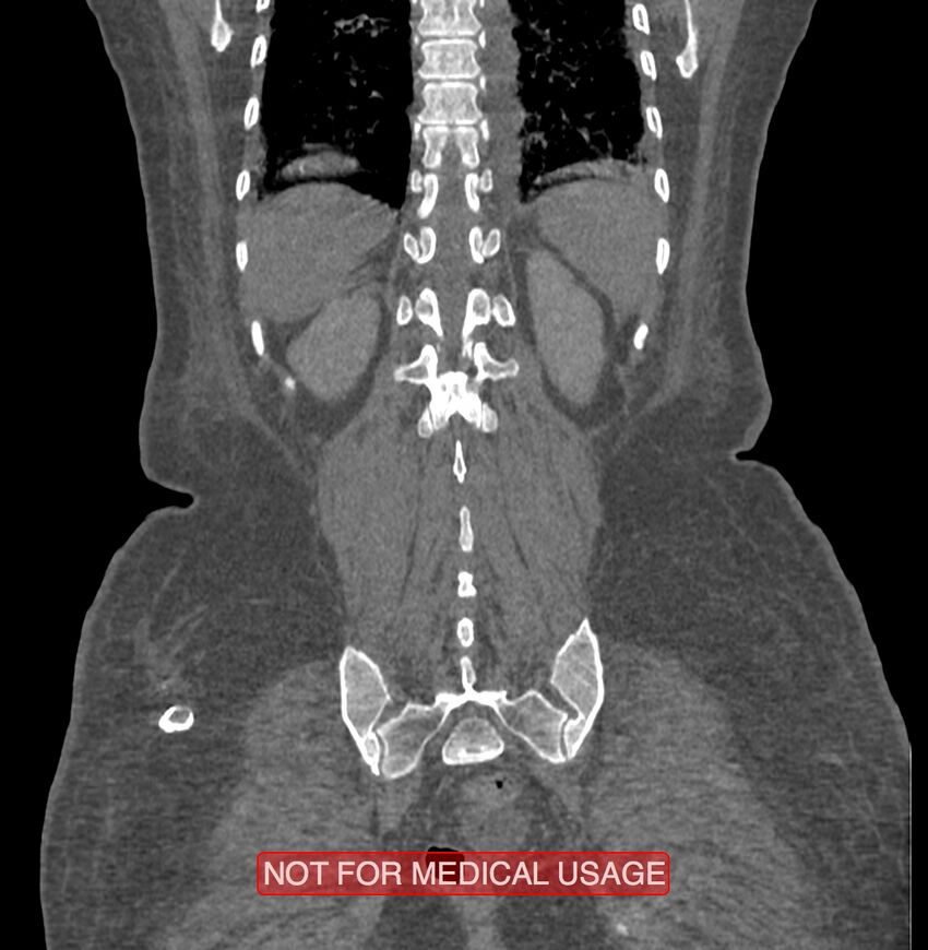 Amoebic enterocolitis with liver abscess (Radiopaedia 35100-36609 B 172).jpg