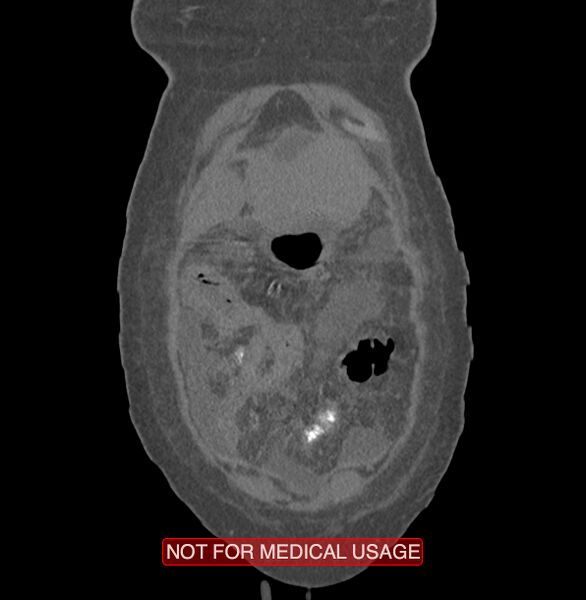 File:Amoebic enterocolitis with liver abscess (Radiopaedia 35100-36609 B 2).jpg