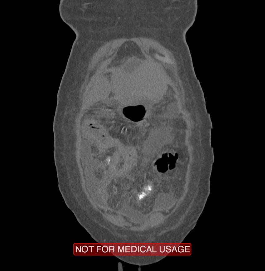 Amoebic enterocolitis with liver abscess (Radiopaedia 35100-36609 B 2).jpg