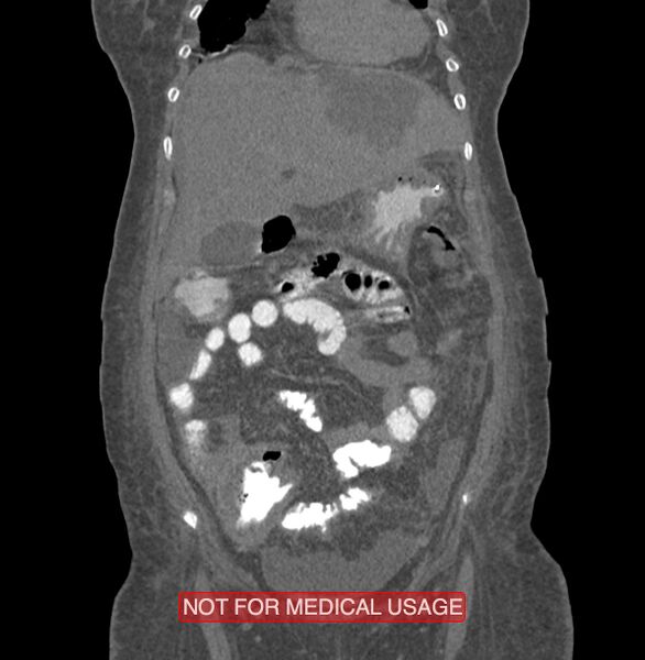 File:Amoebic enterocolitis with liver abscess (Radiopaedia 35100-36609 B 46).jpg
