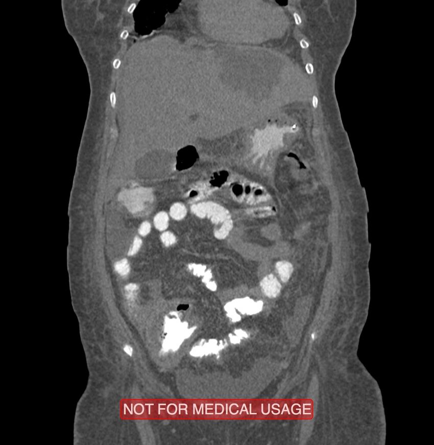 Amoebic enterocolitis with liver abscess (Radiopaedia 35100-36609 B 46).jpg