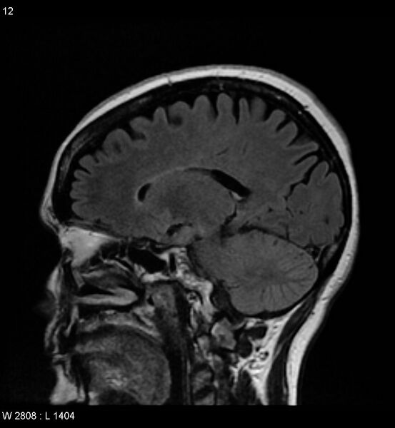 File:Amyotrophic lateral sclerosis (Radiopaedia 5373-7134 Sagittal FLAIR 8).jpg