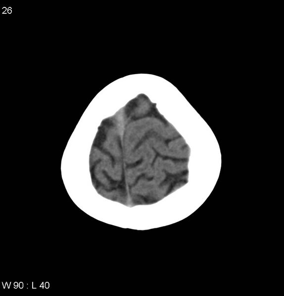 File:Anaplastic astrocytoma NOS (Radiopaedia 40188-42698 Axial non-contrast 26).jpg
