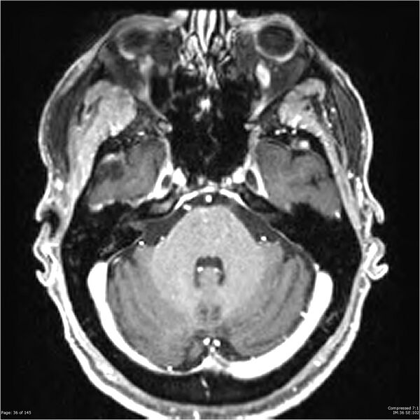 File:Anaplastic meningioma with recurrence (Radiopaedia 34452-35788 Axial T1 C+ 36).jpg