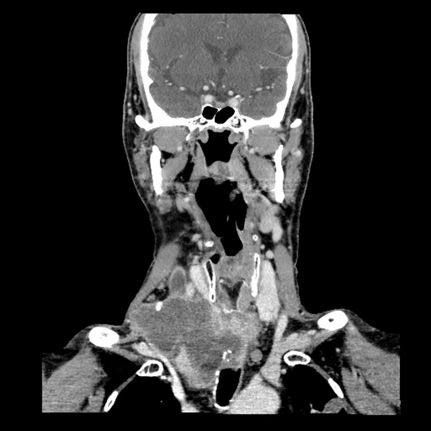 Anaplastic thyroid carcinoma (Radiopaedia 79087-92034 A 58).jpg