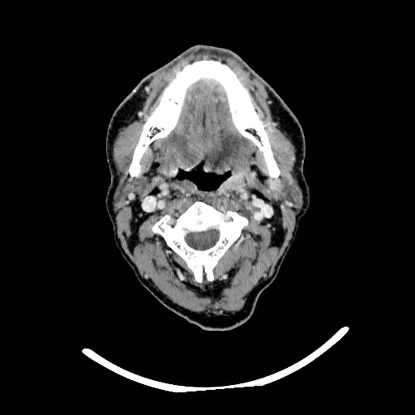 Anaplastic thyroid carcinoma (Radiopaedia 79087-92034 B 90).jpg