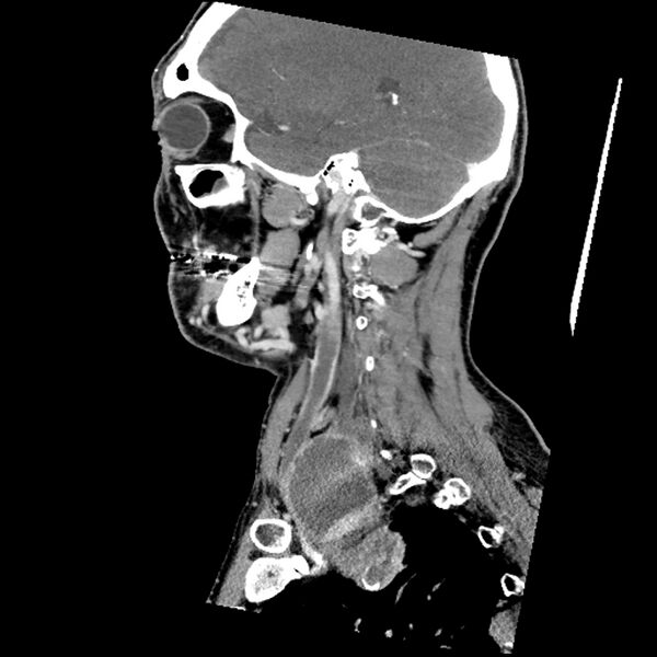 File:Anaplastic thyroid carcinoma (Radiopaedia 79087-92034 C 31).jpg