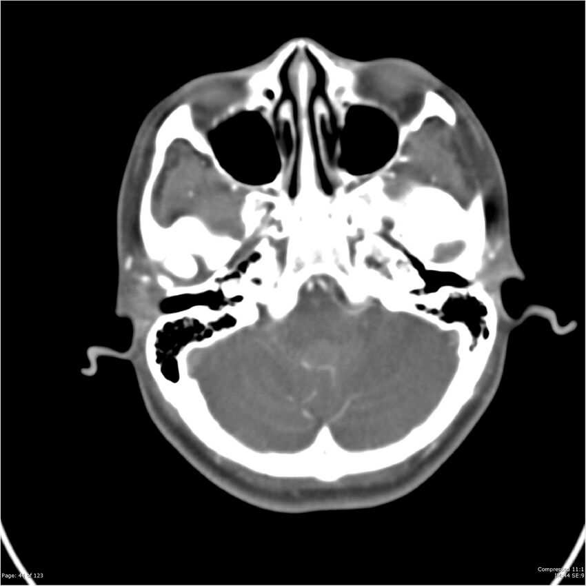 Aneurysmal subarachnoid hemorrhage and Moya Moya disease (Radiopaedia 34306-35593 Axial CT COW 44).jpg