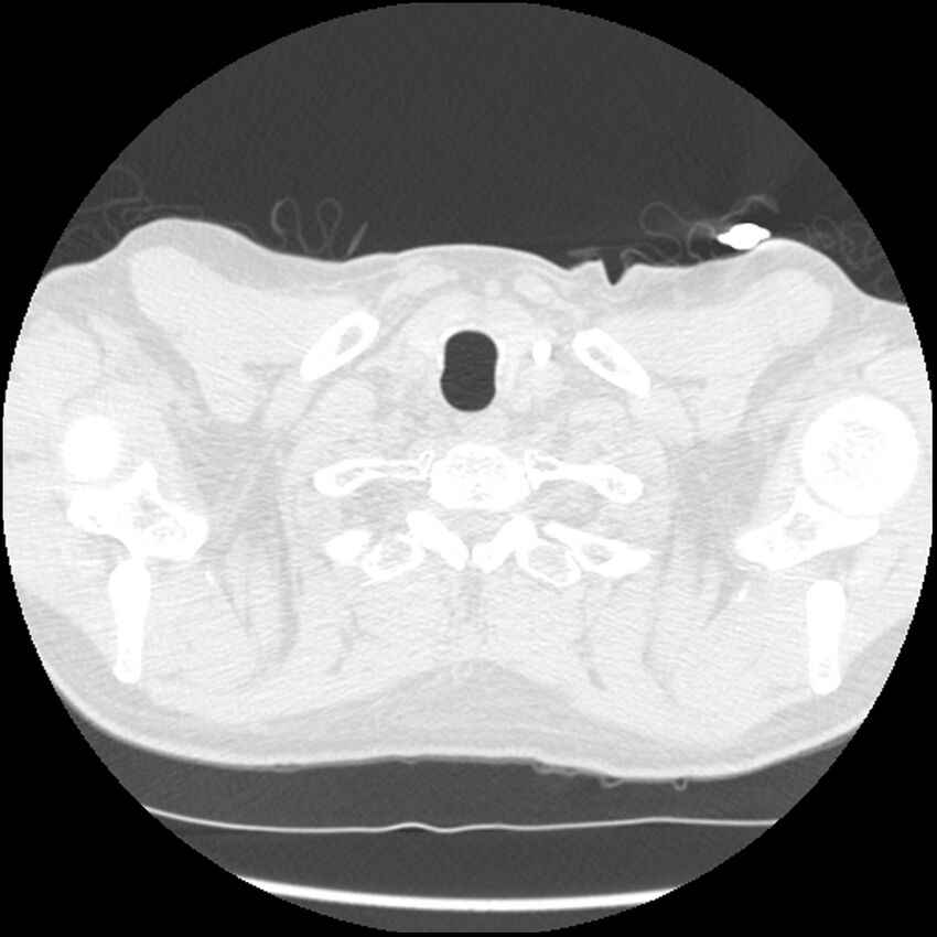 Angioinvasive aspergillosis (Radiopaedia 43957-47466 Axial lung window 2).jpg