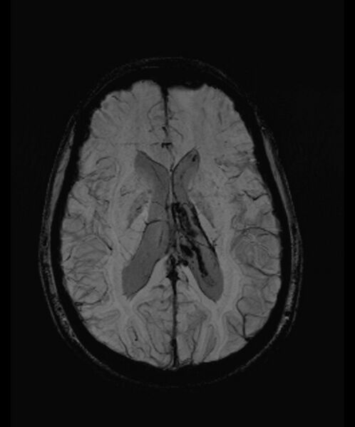 File:Angiomatous meningioma (Radiopaedia 79459-92579 E 37).jpg